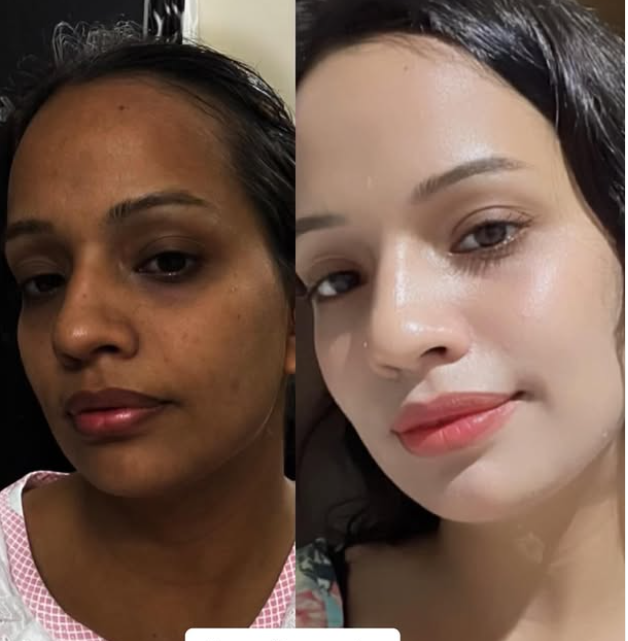 Skin whitening/lightening results tanned skin transformed to lighter, brighter complexion.